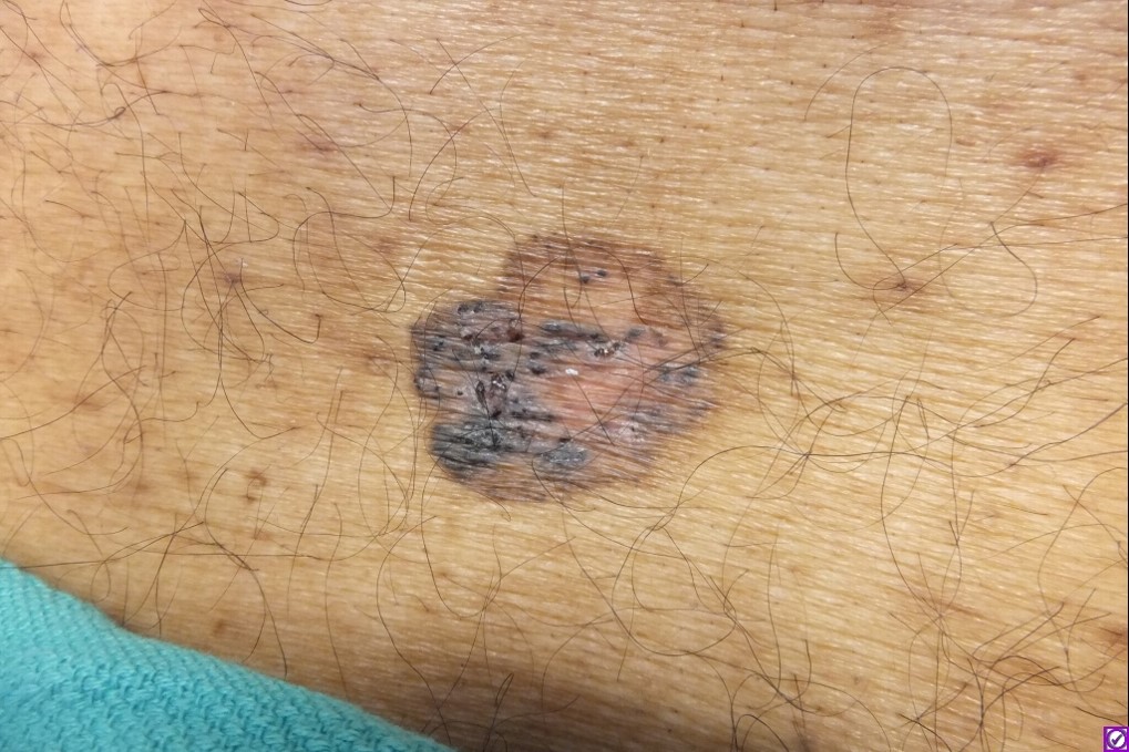 Figure 3 A, Pigmented basal cell carcinoma